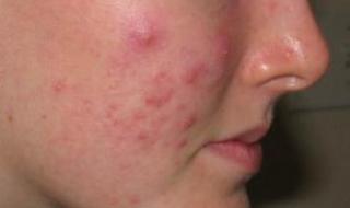 脸上长小疙瘩怎么办